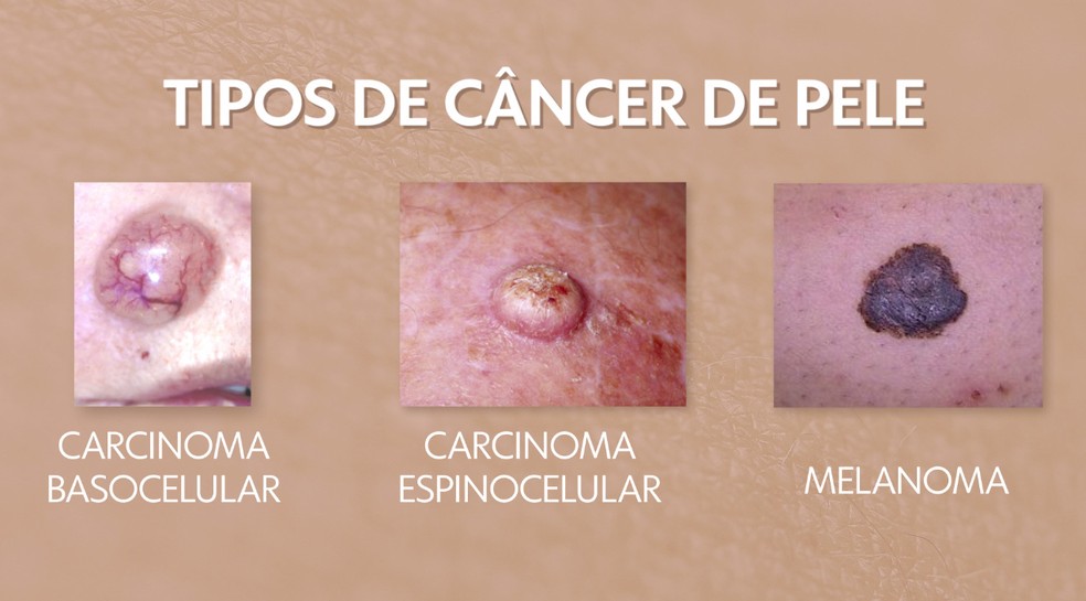 Dermatoscopia Eliane Moreno