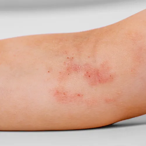 Eczema Relief