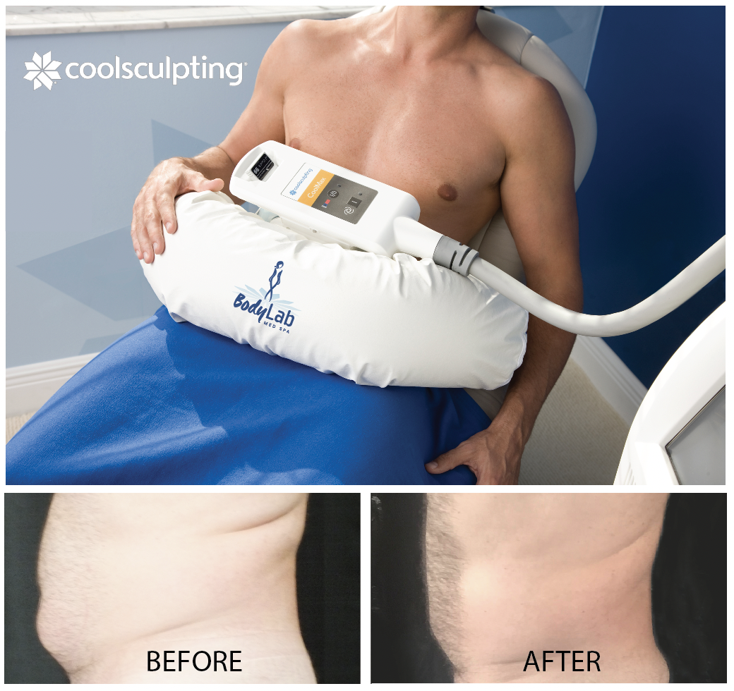 BodyLab Med Spa CoolSculpting