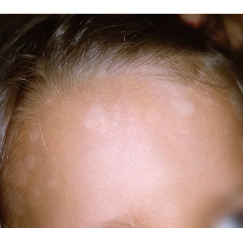 Remedies for Tinea Versicolor