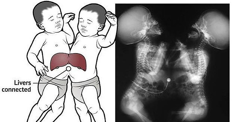 How Do Conjoined Twins Teach A Class?