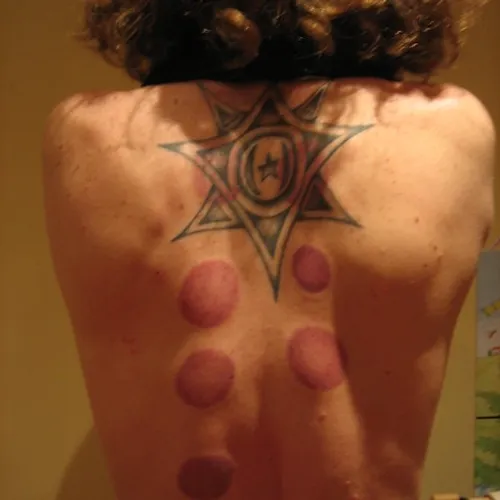 Cupping