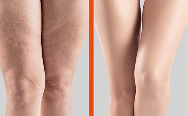 BEFORE AND AFTER RESULTS of using Maryann’s Anti-Cellulite Hot Cream