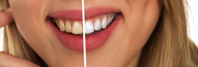 A woman showing her smile with half with white teeth and the rest are yellow