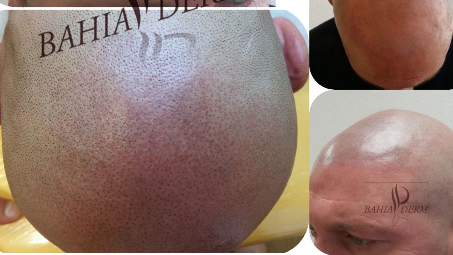 Représentation de la formation : DERMOPIGMENTATION CAPILLAIRE, TRICOPIGMENTATION DEBUTANT      2 JOURS