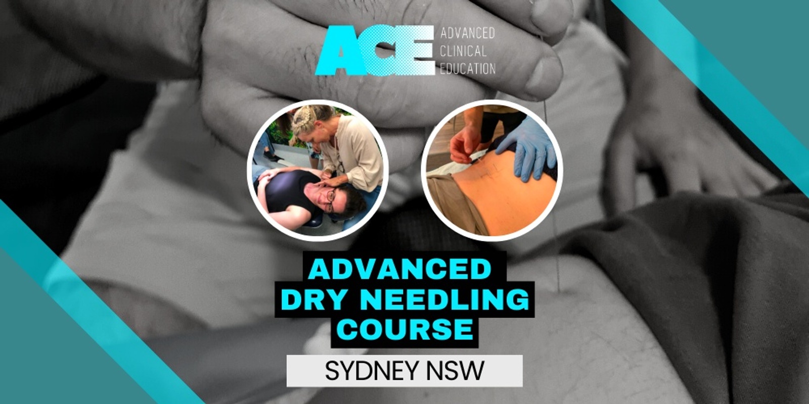 Banner image for Advanced Dry Needling Course (Sydney NSW)