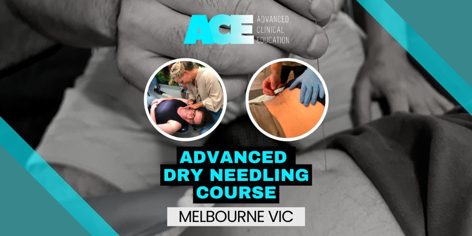 Banner image for Advanced Dry Needling Course (Melbourne VIC)