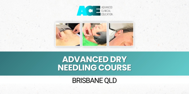 Advanced Dry Needling Course (Brisbane QLD)