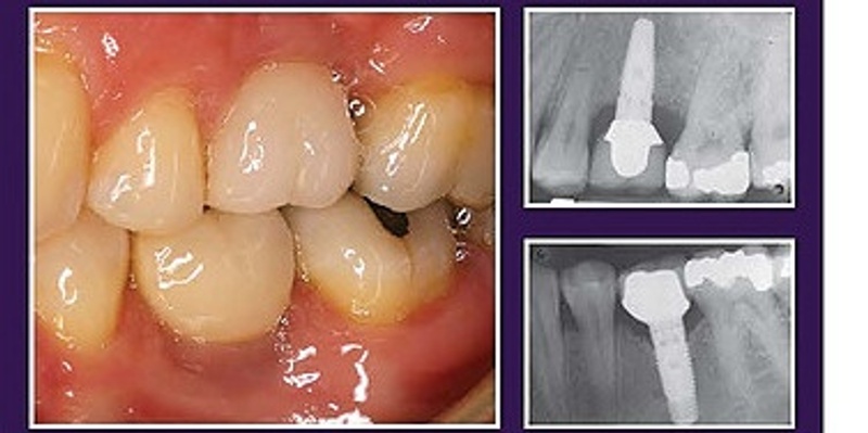 Single Tooth Implant Surgery and Restoration- 2 Locations