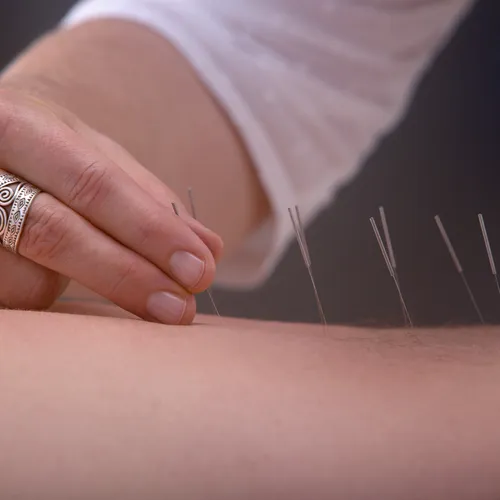 Acupuncture Therapy