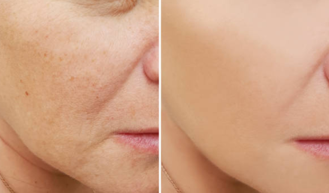 microdermabrasion before and after so is microdermabrasion good for your skin?