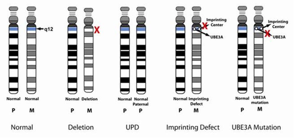 genomic imprinting angelman syndrome