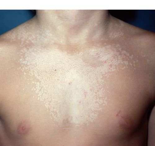 Remedies for Tinea Versicolor