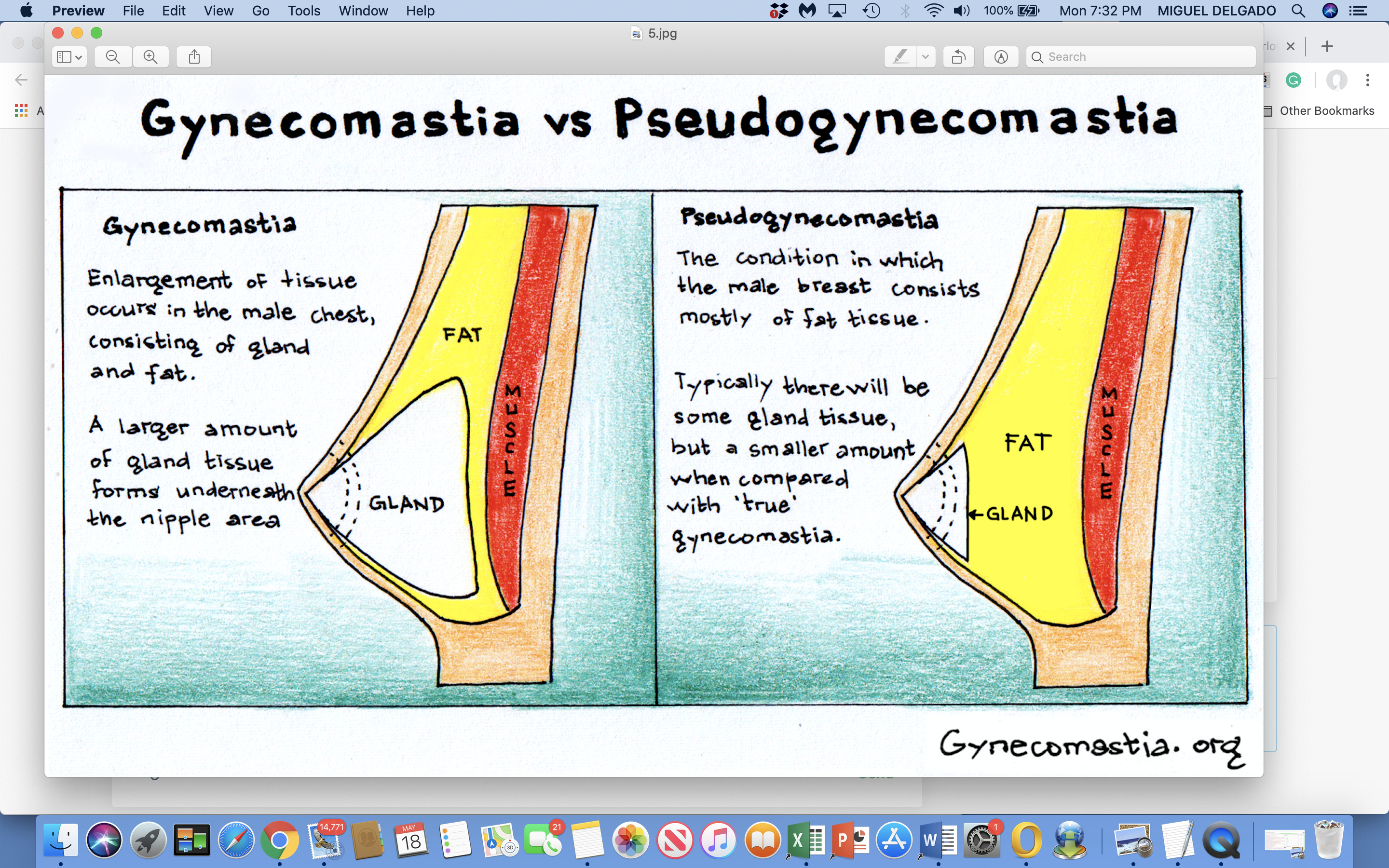  Pseudogynecomastia And Gynecomastia