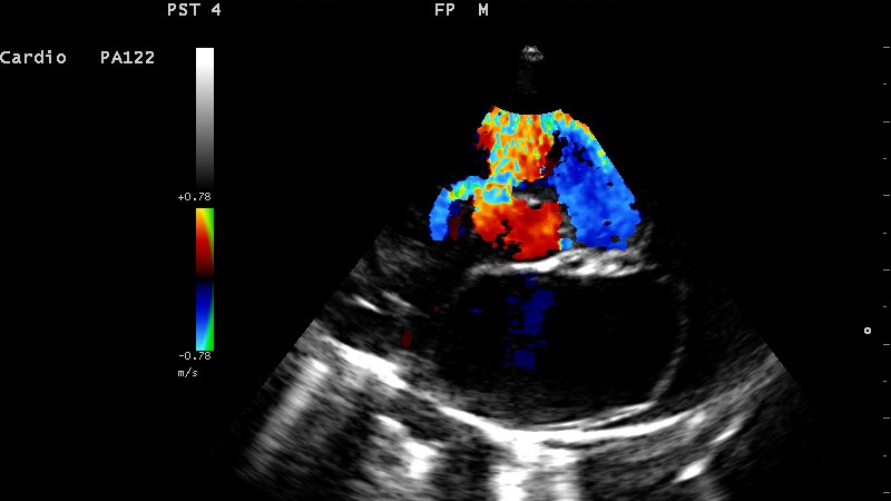 Représentation de la formation : TD Classe virtuelle CAS CLINIQUES Cardiopathies
congénitales: aspect échographique 2D TM et Doppler. Traitements.