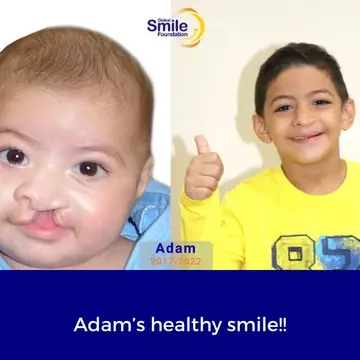 Before and after photos of a young boy who received cleft care