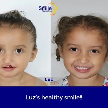 Before and after photos of a young girl who received cleft care