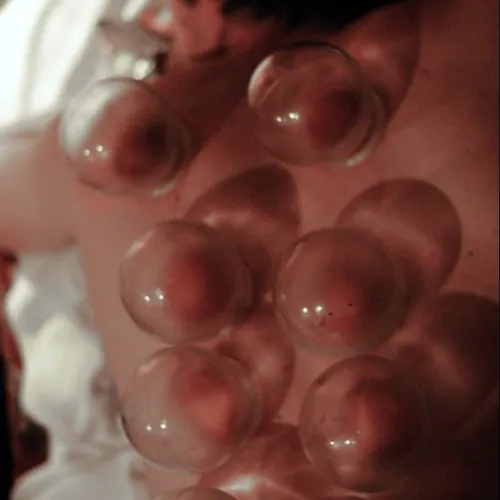 Therapeutic Cupping massage 