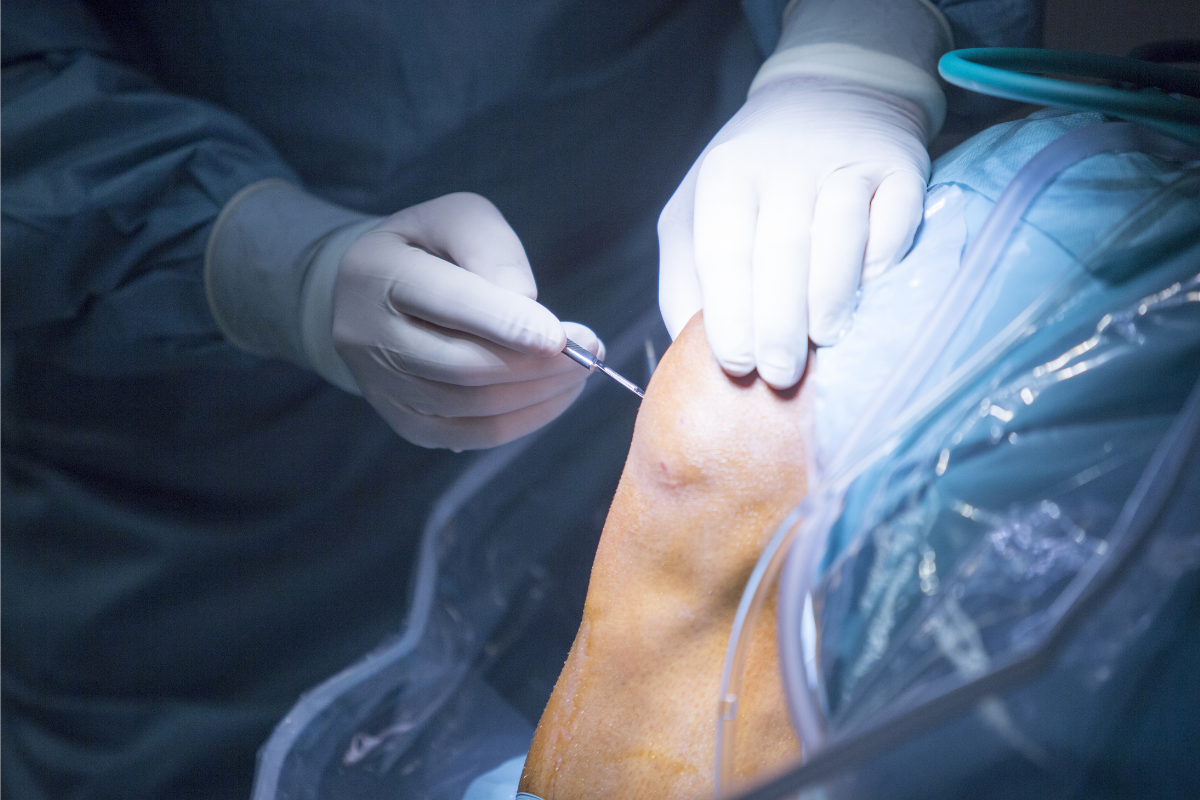 ACL surgery