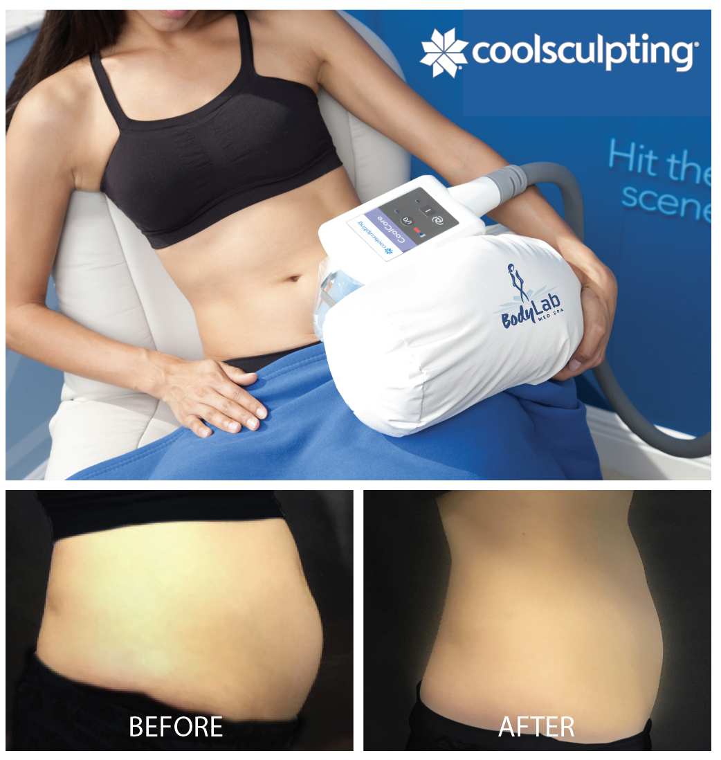 BodyLab Med Spa CoolSculpting