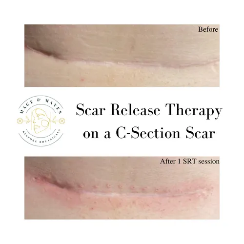 Initial Scar Release Therapy Session